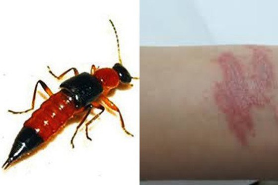 Hà Nội: Hàng nghìn trường hợp nhiễm độc kiến ba khoang phải vào viện - Anh 1