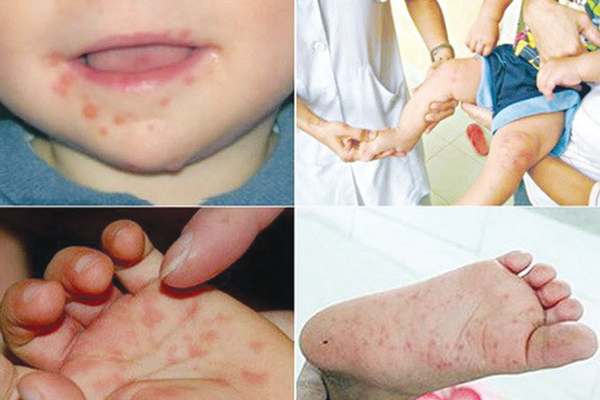 Thông tin không có thuốc điều trị bệnh tay chân miệng là thiếu chính xác - Anh 1