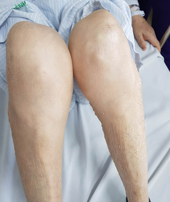Báo động gia tăng tình trạng lạm dụng corticoid - Anh 1