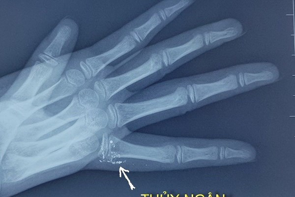Trẻ bị nhiễm độc thuỷ ngân vì vỡ nhiệt kế - Anh 1