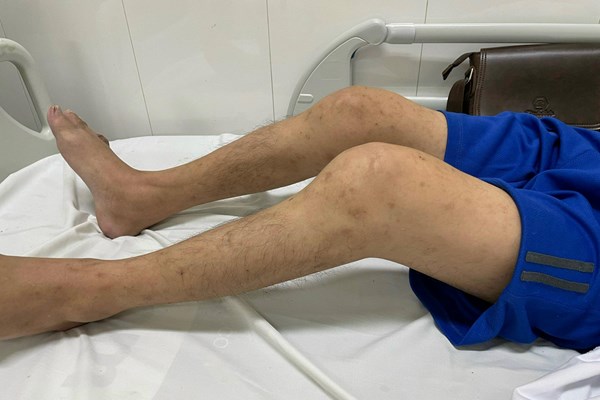 Phòng tránh bệnh gout ở người trẻ - Anh 2