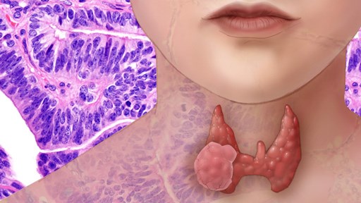 U tuyến giáp trẻ em ít gặp nhưng tỉ lệ ung thư cao - Anh 1