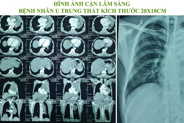 Kon Tum: Phẫu thuật bóc tách thành công khối u trung thất nặng 2kg - Anh 1