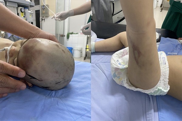 Lâm Đồng: Khởi tố 2 bảo mẫu nghi bạo hành cháu bé 2 tuổi đến nguy kịch - Anh 2