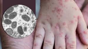 Đẩy mạnh giám sát dịch bệnh đậu mùa khỉ tại các cửa khẩu và các cơ sở khám chữa bệnh - Anh 2