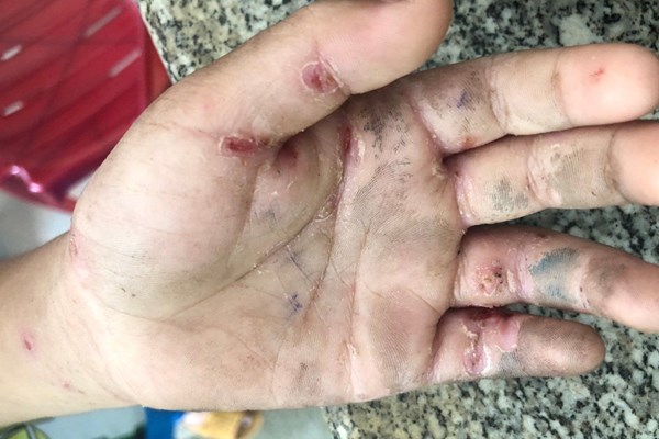 Thêm một xã miền núi Quảng Ngãi xuất hiện bệnh ghẻ - Anh 1