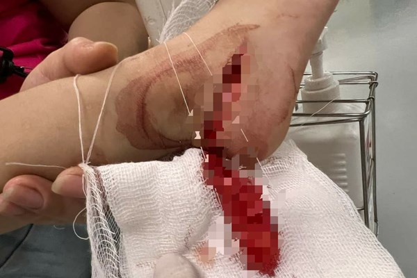 Bị thương nặng vì bất cẩn với dao, máy xay đa năng - Anh 1