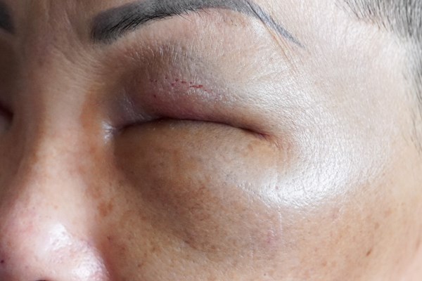Bị lừa tiêm filler giá rẻ, bệnh nhân bị tai biến và mất sạch tài sản - Anh 1