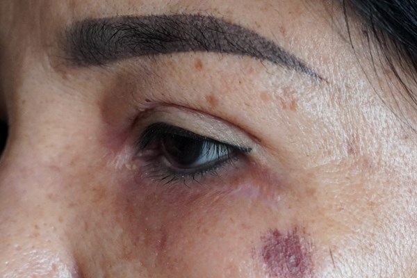 Bị lừa tiêm filler giá rẻ, bệnh nhân bị tai biến và mất sạch tài sản - Anh 2