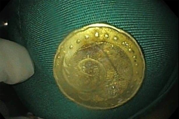 Gắp thành công đồng xu mắc trong thực quản bé gái 5 tuổi - Anh 2