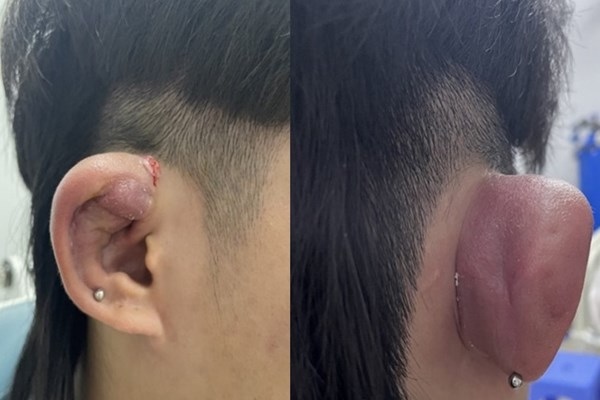 Hiểm hoạ từ xỏ khuyên trên vành tai - Anh 1