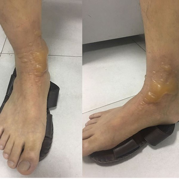 Bỏng vì đi… mát-xa - Anh 1