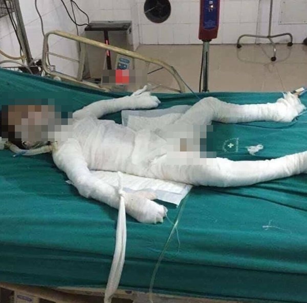 Hà Nội: Bé trai 6 tuổi bị bố dượng tẩm xăng đốt đã qua đời sáng nay - Anh 1