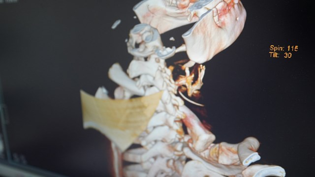 Nam thanh niên phải phẫu thuật chỉ vì chủ quan với hóc xương cá