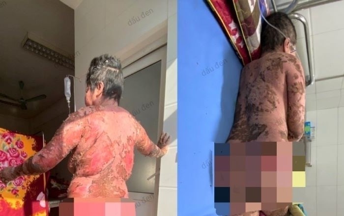 Suýt mất mạng vì tự ý sử dụng thuốc nam không rõ nguồn gốc - Anh 1