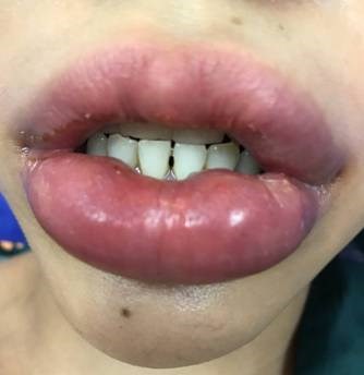 Sưng vù môi vì... làm đẹp - Anh 1