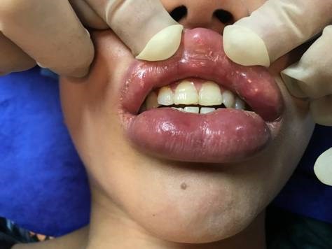 Sưng vù môi vì... làm đẹp - Anh 2