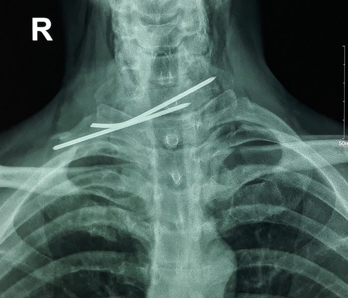 Cần Thơ: Phẫu thuật thành công bệnh nhân bị đinh đâm xuyên thực quản, khí quản - Anh 1
