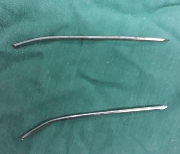 Cần Thơ: Phẫu thuật thành công bệnh nhân bị đinh đâm xuyên thực quản, khí quản - Anh 2