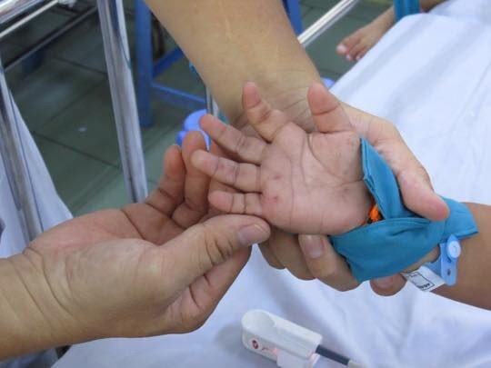 Không để dịch tay chân miệng lây lan trong cộng đồng - Anh 1