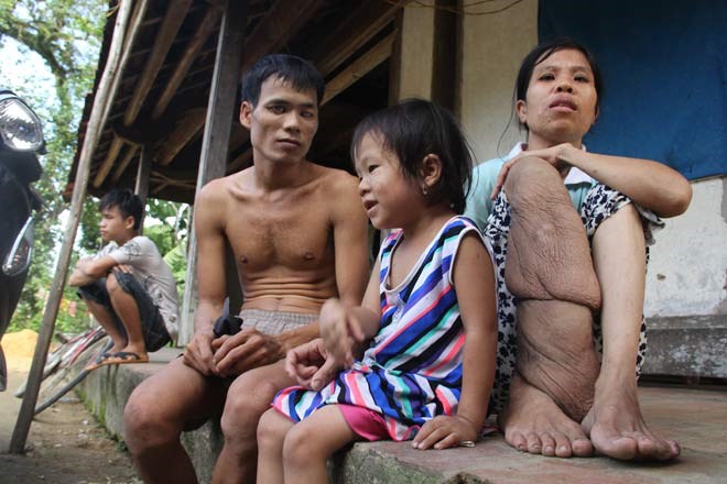 Cảm động chuyện tình “rổ rá” giữa cô nàng “chân voi” và anh chàng mù - Anh 1